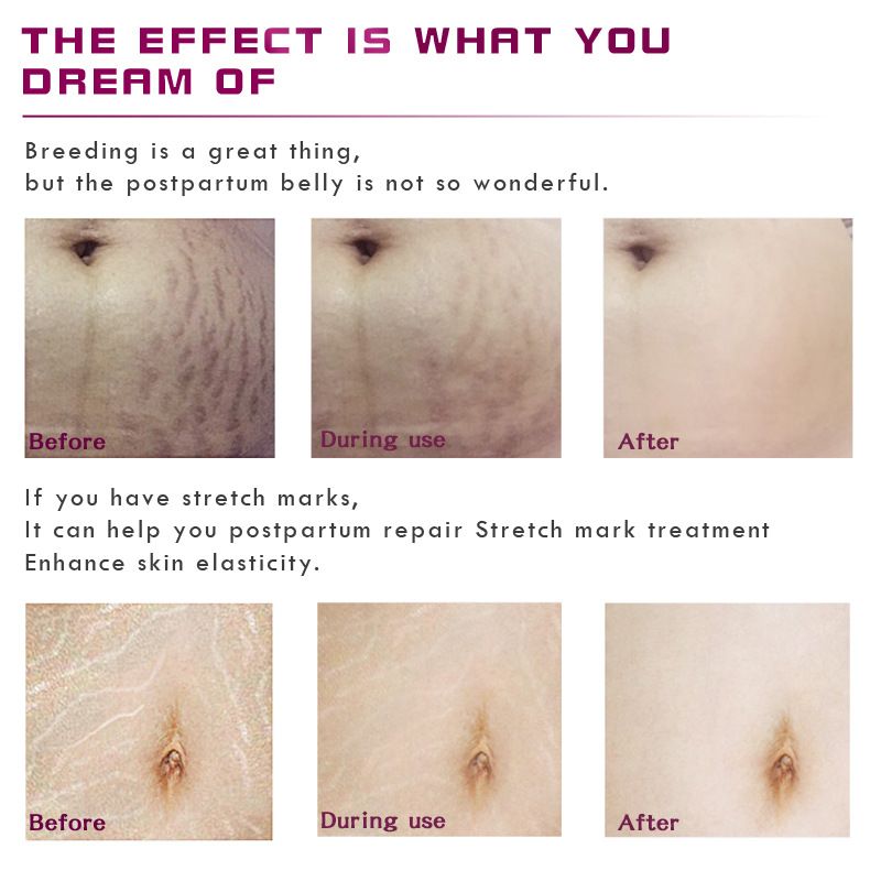 Stretch Mark Remover Essential Oil